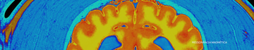 aging brain MRI scan